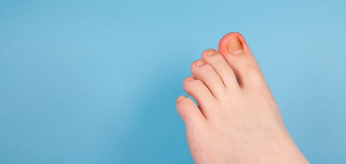 Ingrown Toenail Problem. Infected Foot Check. Podiatry Patient. Treats ingrown nail.