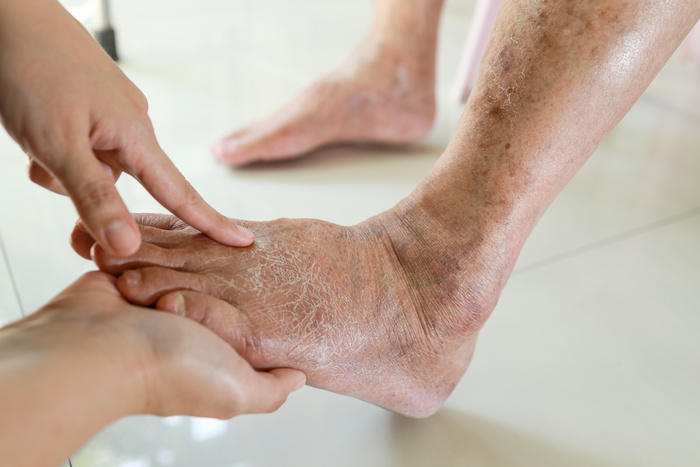 Hands of a podiatrist examining a diabetic foot of a patient