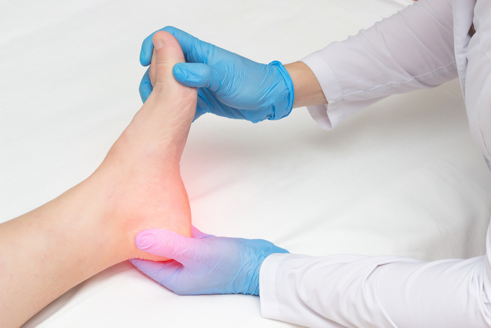 Doctor examines the sore heel of a woman who has a heel spur