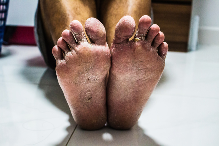 Men's feet with fungus, The skin peels off into wounds, Athlete's Foot, Tinea pedis, Fungal infection.