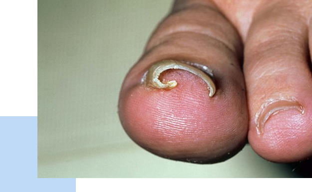Ingrown Toenails